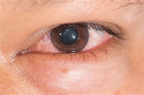 Chemosis in the Eye: Causes, Symptoms & Treatment .